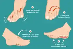 Symptoms of athelete's Foot.