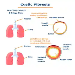 image showing what happens to your airways with cystic fibrosis