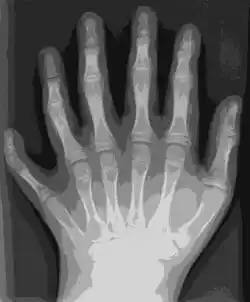 image showing the extra finger on an X-ray