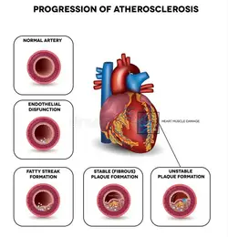 image showing the progression of atherosclerosis