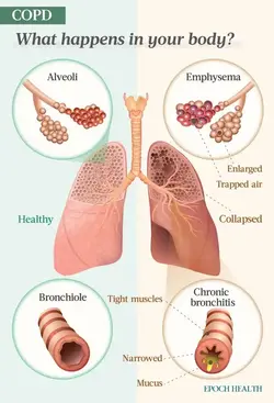 infographic on COPD