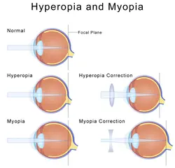 long and short sighted eyes and how they are corrected