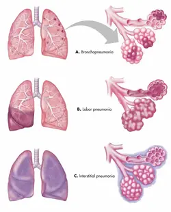 image of the types of pneumonia