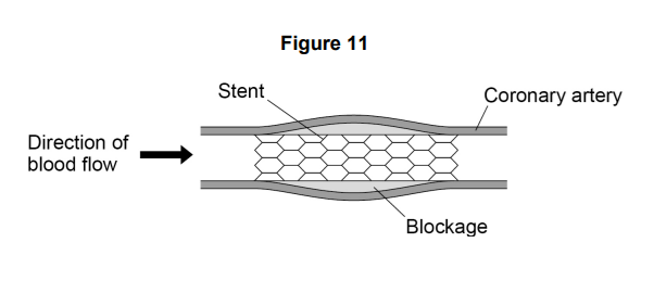 Figure 11 showing a stent placed inside an artery