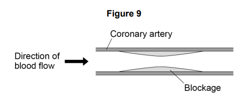 Figure 9 showing a coronary artery and blockage