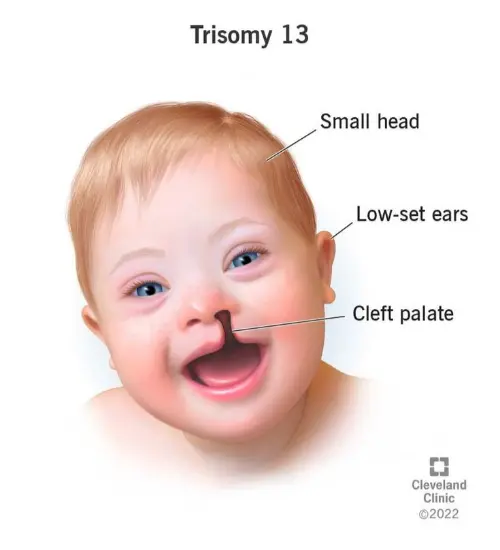 Patau syndrome anatomy