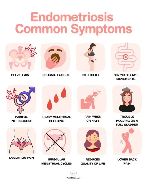 Symptoms of Endometriosis