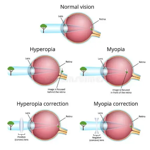 Hyperopia and myopia